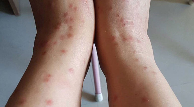 Women's legs with flea bites.