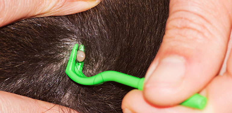 A hand using an instrument to remove a tick from a human head.