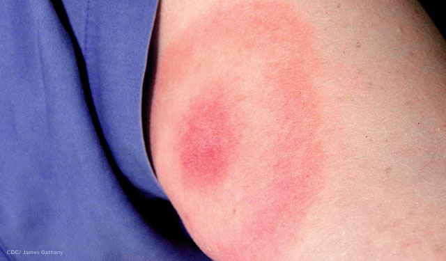 A bull's-eye rash manifested at the site of a tick bite, on a woman’s posterior upper arm.