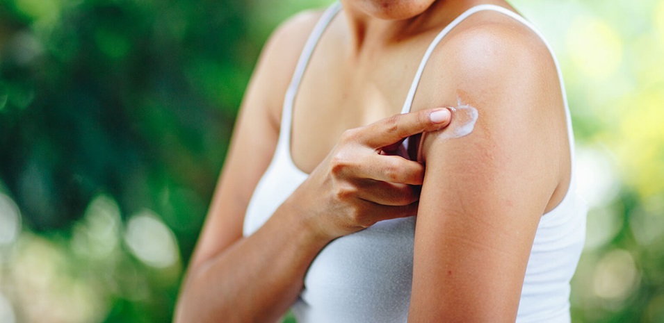 Una joven aplicando una loción para la comezón en una picadura de mosquito en el brazo.