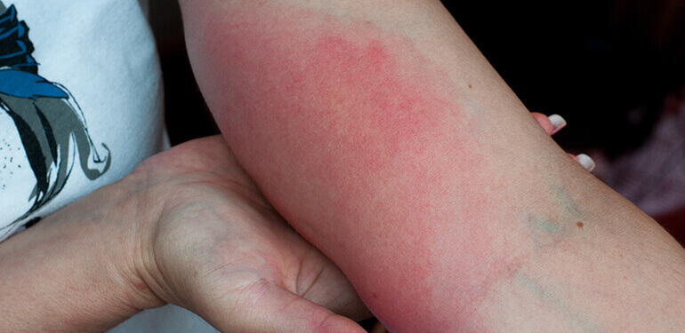 El brazo rojo e hinchado de una persona con una picadura de avispa.